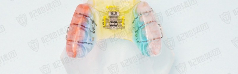 三维扩弓矫治器