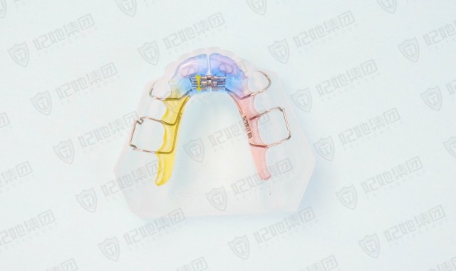 舌簧式螺旋簧横向扩弓矫治器（下颌）