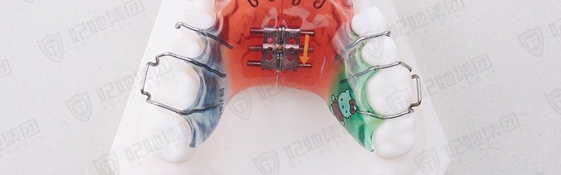 舌簧式螺旋簧横向扩弓矫治器（上颌）