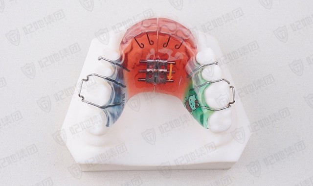 舌簧式螺旋簧横向扩弓矫治器（上颌）