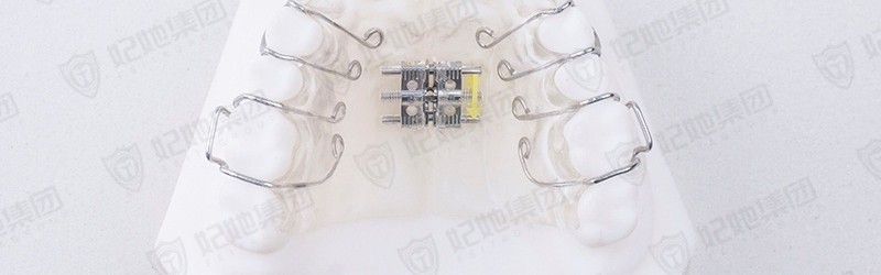 螺旋簧横向扩弓矫治器（上颌）