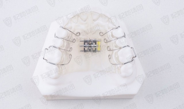 螺旋簧横向扩弓矫治器（上颌）