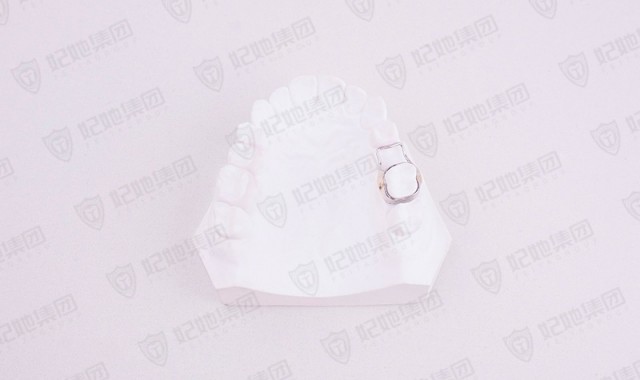 单端缺隙保持器（激光焊接）