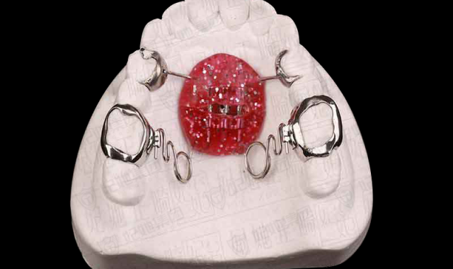 钟摆式螺旋簧磨牙后移矫治器