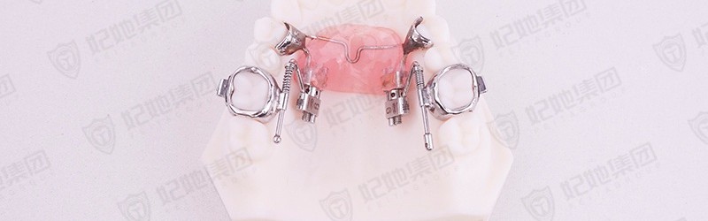 Forg蛙式双侧磨牙远移矫治器 