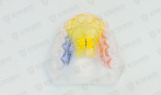 隐形横向扩弓矫治器