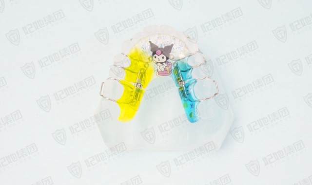 螺旋簧双侧磨牙后移矫治器