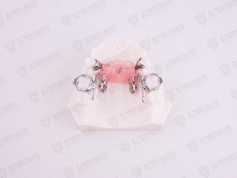 076-Forg蛙式双侧磨牙远移矫治器 (进口).jpg